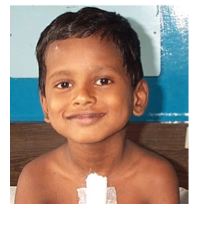 Ranjith Kumar - Atrial Septal Defect